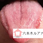 口腔カンジダ症の舌